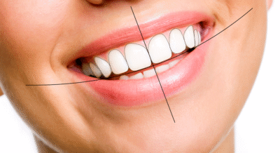ساخت لمینیت و ونیرهای سرامیکی